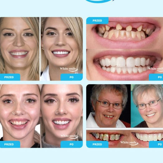SMILEFIT PRO – SET ADAPTABIL DE DINȚI PENTRU UN ZÂMBET PERFECT